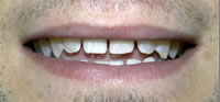 ZOOM Tooth Whitening | Porcelain Veneers | Fort Worth