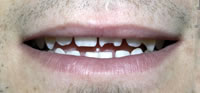 ZOOM Tooth Whitening | Porcelain Veneers | Fort Worth