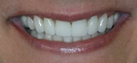 ZOOM Tooth Whitening | Porcelain Veneers | Fort Worth