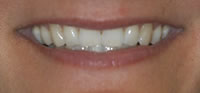 ZOOM Tooth Whitening | Porcelain Veneers | Fort Worth