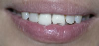 ZOOM Tooth Whitening | Porcelain Veneers | Fort Worth