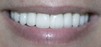 ZOOM Tooth Whitening | Porcelain Veneers | Fort Worth
