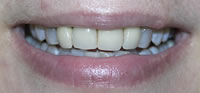 ZOOM Tooth Whitening | Porcelain Veneers | Fort Worth