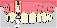 ZOOM Tooth Whitening | Porcelain Veneers | Fort Worth