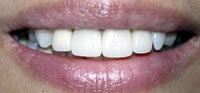 ZOOM Tooth Whitening | Porcelain Veneers | Fort Worth