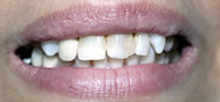 ZOOM Tooth Whitening | Porcelain Veneers | Fort Worth