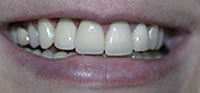 ZOOM Tooth Whitening | Porcelain Veneers | Fort Worth