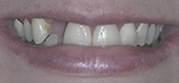 ZOOM Tooth Whitening | Porcelain Veneers | Fort Worth