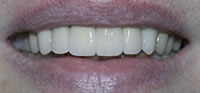 ZOOM Tooth Whitening | Porcelain Veneers | Fort Worth