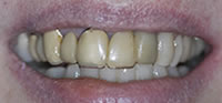 ZOOM Tooth Whitening | Porcelain Veneers | Fort Worth