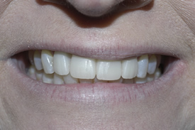 Dental Crowns | Dental Bridges Fort Worth TX | Arlington TX