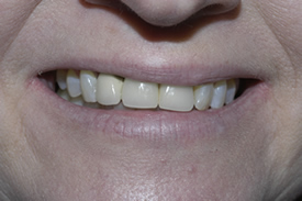 Dental Crowns | Dental Bridges Fort Worth TX | Arlington TX