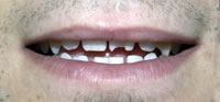 Dental Veneers | Dental Crowns | Dental Bridges Fort Worth TX | Arlington TX