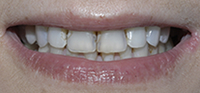 Dental Crowns | Dental Bridges Fort Worth TX | Arlington TX