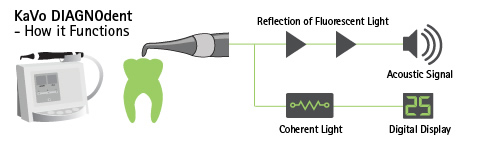 Laser Cavity Detection Fort Worth TX | Arlington TX