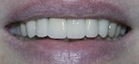 Dental Crowns | Dental Bridges Fort Worth TX | Arlington TX