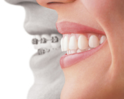 Orthodontics | Invisalign® Fort Worth TX | Arlington TX